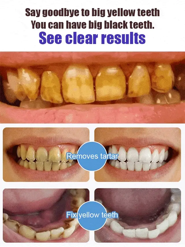 Intensive Teeth Whitening Toothpaste ( Buy 1 Get 1 Free ) - Image 4