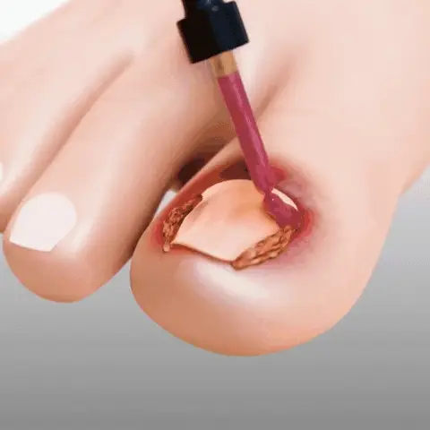 COMPLETE NAIL PROTECTION SERUM - BUY 1 GET 1 FREE - Image 3