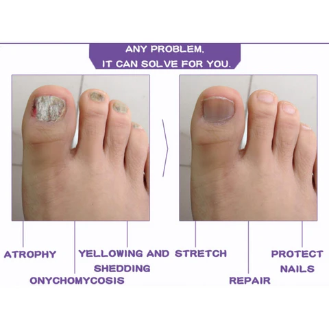 COMPLETE NAIL PROTECTION SERUM - BUY 1 GET 1 FREE - Image 6